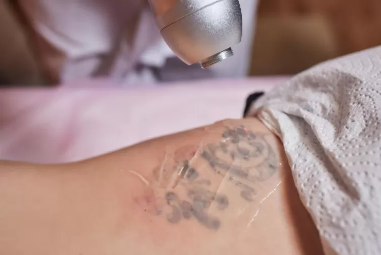 Understanding the Impact of Different Skin Types on Tattoo Removal